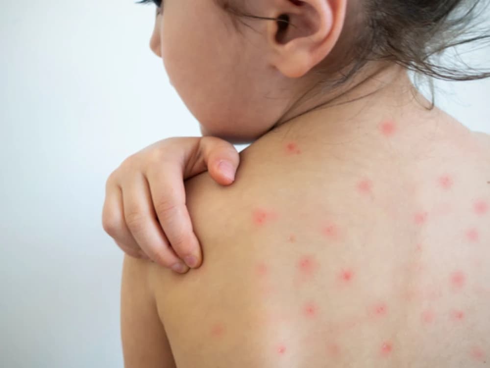 “O surgimento de surtos de sarampo é alarmante”, alerta infectologista de Tubarão